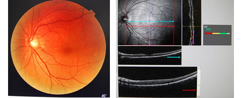 OCT（光干渉断層計）導入しました ｜ 春日井市 浅野眼科クリニック